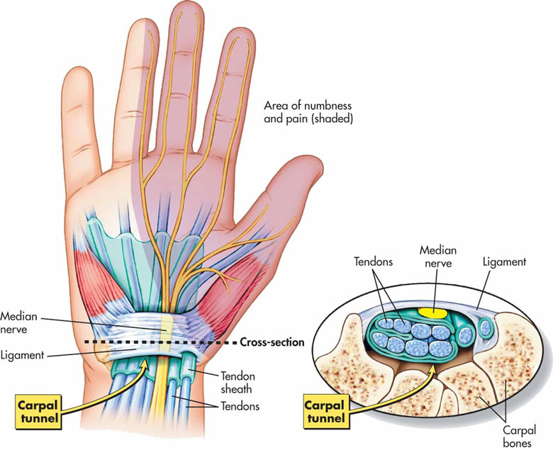 سندرم تونل کارپال (نشانگان دالان مچ دست) - سندروم, جراحی, اعصاب دست - %d8%a8%db%8c%d9%85%d8%a7%d8%b1%db%8c-%d9%87%d8%a7