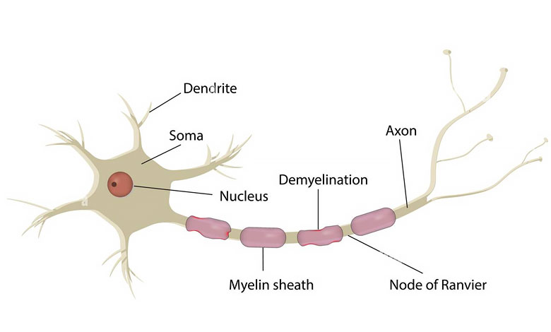 بیماری نورون حرکتی (موتور نورون) - شبکه عصبی, سیستم عصبی, بیماری عصبی - %d8%a8%db%8c%d9%85%d8%a7%d8%b1%db%8c-%d9%87%d8%a7